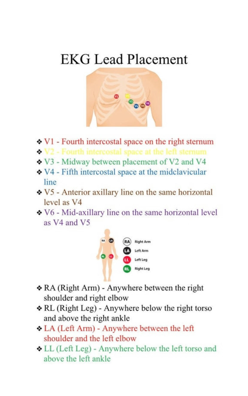 EKG Placement